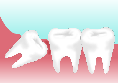 親知らずの抜歯 与野歯科 矯正歯科